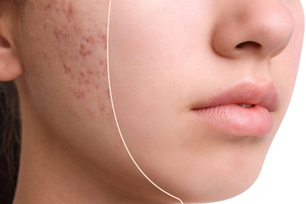 قرص راکوتان چیست؟ همه‌چیز درباره قاتل جوش‌های سرسخت