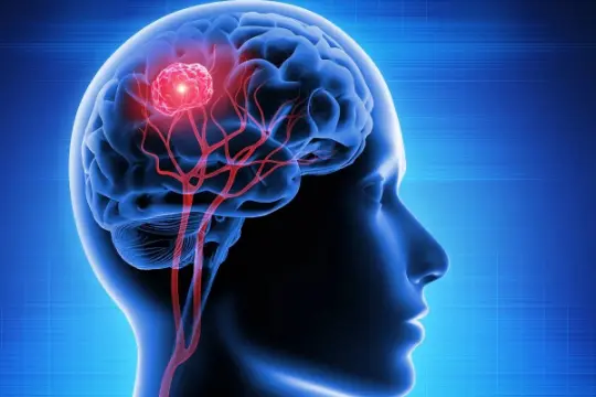 پربازدیدترین مطالب فناوری و علمی زومیت در سال ۲۰۲۳ 6 علائم تومور مغزی
