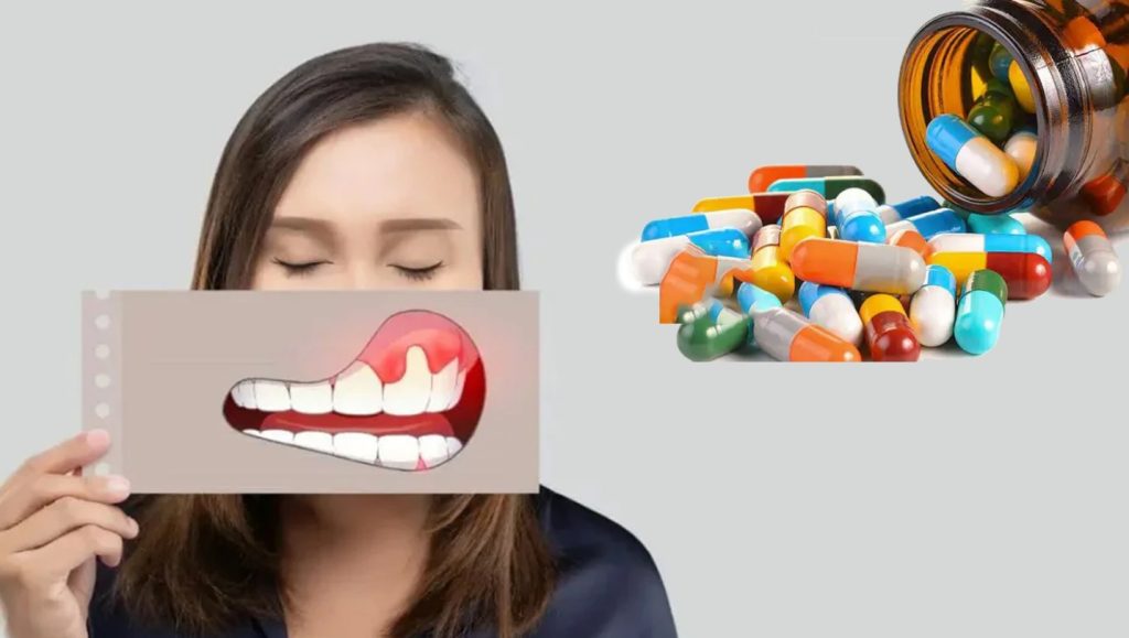 بهترین آنتی‌بیوتیک‌ها برای درمان عفونت ایمپلنت دندان