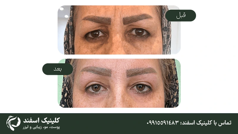 قبل و بعد عمل بلفاروپلاستی در یک خانم