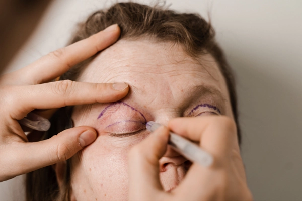 پزشک در حال آماده سازی پلک یک خانم مسن برای انجام عمل بلفاروپلاستی